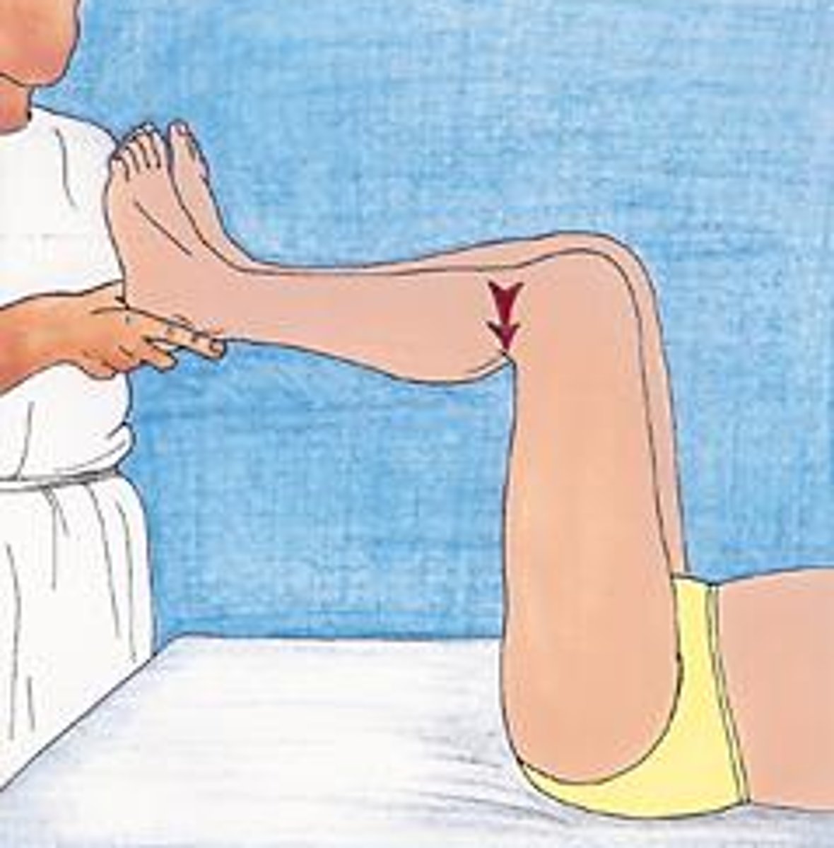 <p>What is a (+) sag sign?</p>