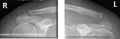 <p>Sprain, subluxation (partial dislocation), and complete dislocation.</p>