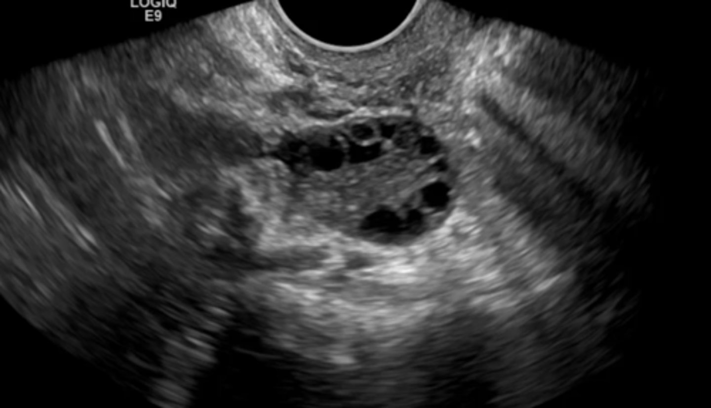 <p>Polycystic ovarian disease</p><p>-This ovary has the string of pearls appearance consistent with PCOS</p>
