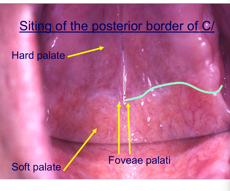 <p>mark where you think the posterior border should be with a pen when you take the impassion on a disinfected dry impression</p>