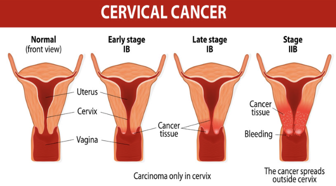<ul><li><p><strong>EFFECT</strong></p><ul><li><p>Affects 450,000 women worldwide each year, killing half </p></li><li><p>Most common between ages 30 and 50 </p></li></ul></li><li><p><strong>RISK</strong></p><ul><li><p>Frequent cervical inflammation </p></li><li><p>STIs, including HPV</p></li></ul></li></ul><p></p>