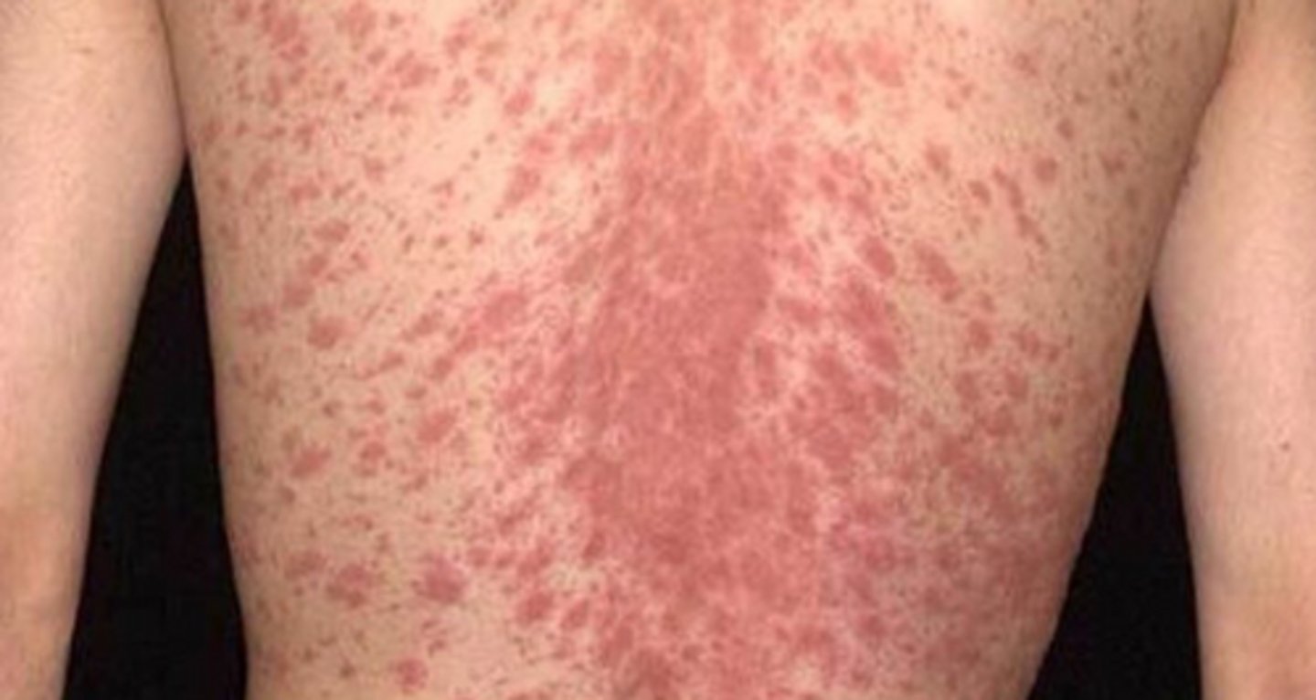 <p>name this skin pathology</p>