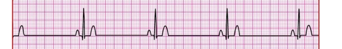 <p>Sinus bradycardia</p>