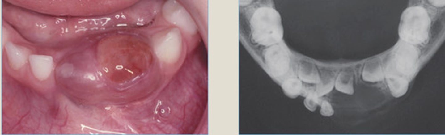 <p>Blue-purple mass present on the anterior alveolar ridge of a 4 yr old boy</p><p>*cortical expansion</p>