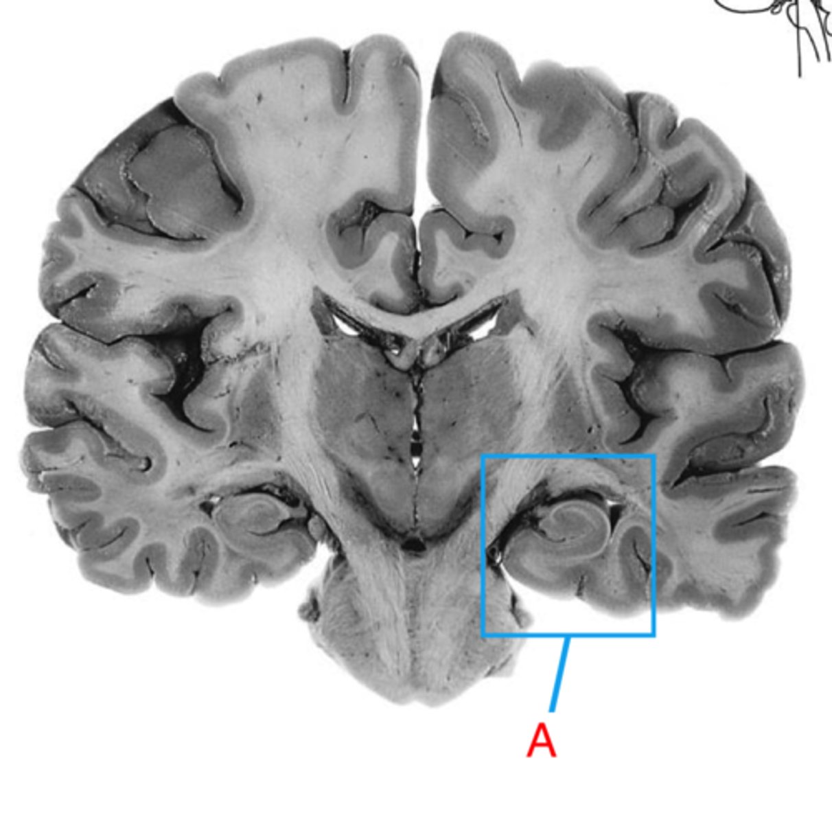 <p>the region of the brain more caudal than the amygdala, snail appearance medial in the temporal lobe. Appears with the thalamus+third ventricle. plays a role in memory.</p>