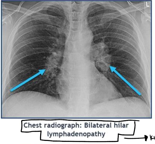 <p><span style="font-family: &quot;Courier New&quot;;">o</span><span style="font-family: &quot;Times New Roman&quot;; line-height: normal; font-size: 7pt;">&nbsp;&nbsp; </span><span>Labs: elevated ACE (watch for HTN), elevated calcium (calcitriol prod)</span></p><p class="MsoListParagraphCxSpMiddle"><span>§</span><span style="font-family: &quot;Times New Roman&quot;; line-height: normal; font-size: 7pt;">&nbsp; </span><span>Both made by granulomas</span></p><p class="MsoListParagraphCxSpMiddle"><span style="font-family: &quot;Courier New&quot;;">o</span><span style="font-family: &quot;Times New Roman&quot;; line-height: normal; font-size: 7pt;">&nbsp;&nbsp; </span><span>Lung biopsy: noncaseating granuloma</span></p><p class="MsoListParagraphCxSpMiddle"><span style="font-family: &quot;Courier New&quot;;">o</span><span style="font-family: &quot;Times New Roman&quot;; line-height: normal; font-size: 7pt;">&nbsp;&nbsp; </span><span>Imaging: bilateral hilar adenopathy</span></p><p class="MsoListParagraphCxSpMiddle"><span>-</span><span style="font-family: &quot;Times New Roman&quot;; line-height: normal; font-size: 7pt;">&nbsp;&nbsp;&nbsp;&nbsp;&nbsp;&nbsp;&nbsp;&nbsp;&nbsp;&nbsp;&nbsp;&nbsp;&nbsp; </span><span>Tx:</span></p><p class="MsoListParagraphCxSpLast"><span style="font-family: &quot;Courier New&quot;;">o</span><span style="font-family: &quot;Times New Roman&quot;; line-height: normal; font-size: 7pt;">&nbsp;&nbsp; </span><span>75% of people recover without treatment, with treatment we use methotrexate first line over steroids (can use steroids though)- normally opposite</span></p><p><span style="font-family: Aptos, sans-serif; line-height: 115%;">Serial PFTs to see progression and guide, pulmonary fibrosis may cause death - KNOW CXR </span></p>