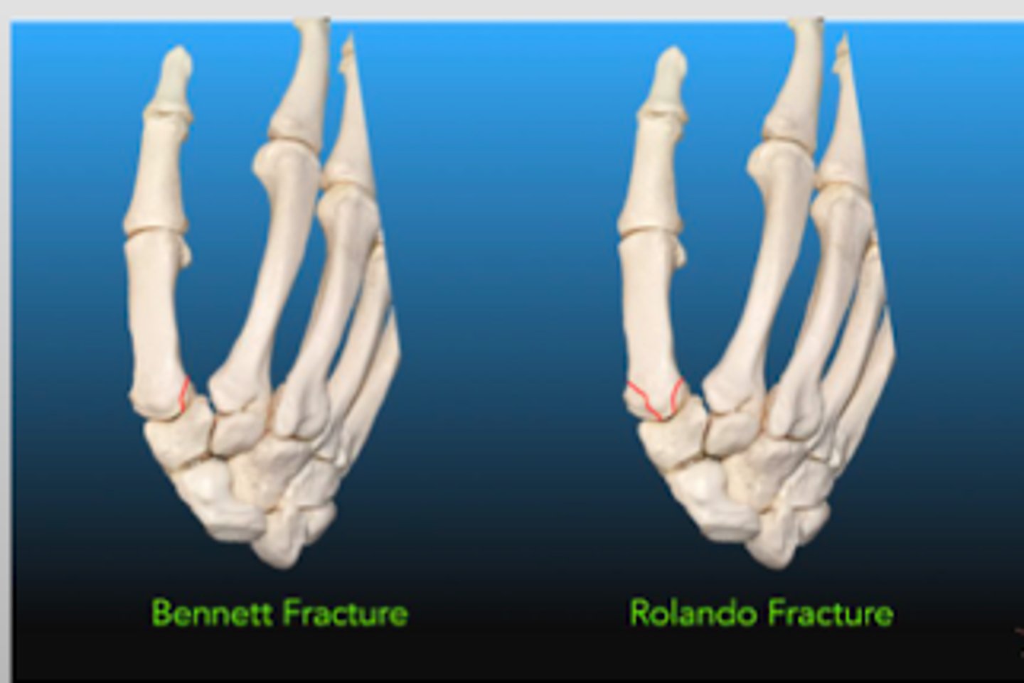 <p>Bennett's → oblique Fx</p><p>Rolando's → comminuted/displaced Fx</p>