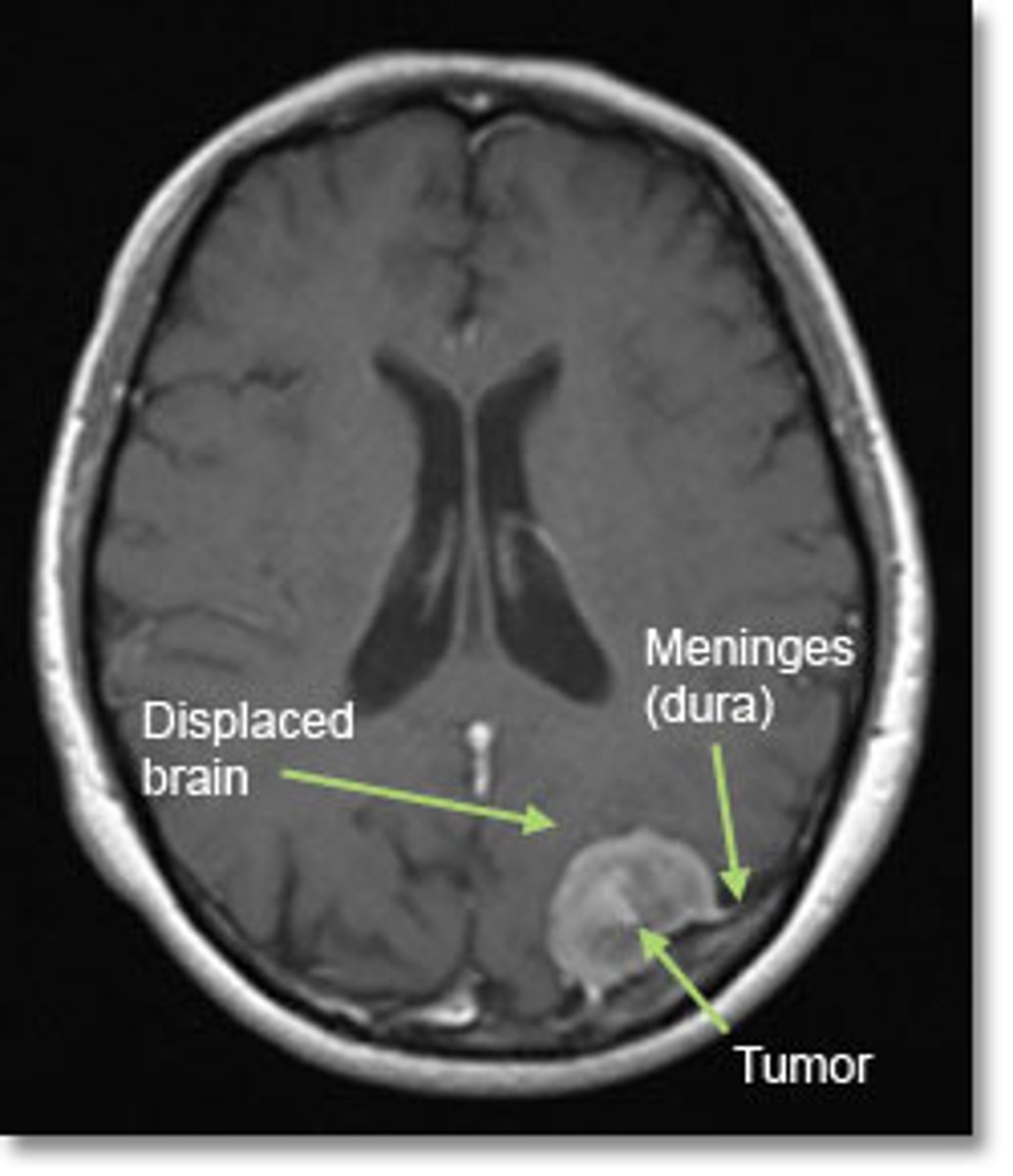 <p>benign tumor of the coverings of the brain (the meninges). Most common CNS tumor</p>