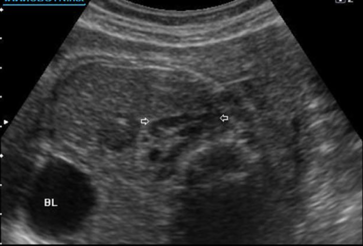 <p>what are the white arrows pointing to</p><p>a) neuroblastoma</p><p>b) normal adrenal gland</p><p>c) normal kidney</p><p>d) collapsed bowel</p>