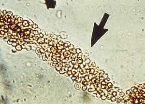 This cast is indicative of bleeding within the nephron; associated with damage to the glomerulus (Glomerulonephritis)

