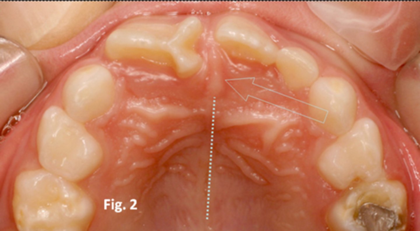 <p>Small bulge of tissue at the most anterior part of the hard palate</p>