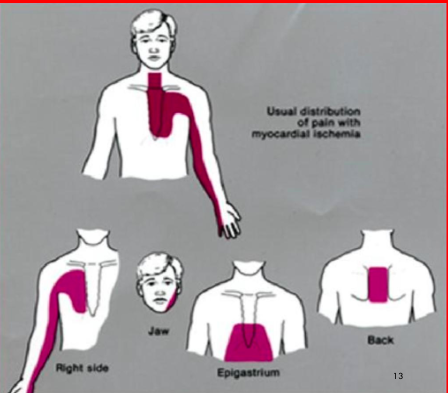 <p>ischemic chest pain location</p>