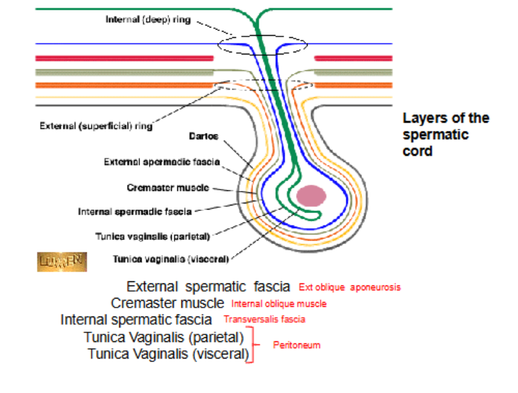 <p>the peritonium, transvers fascia, internal obique muscle and external oblique muscle </p>