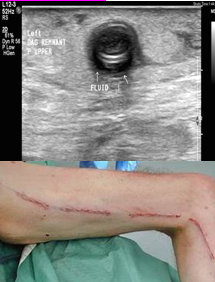 <p>Pt s/p bypass graft (Fem-Tib) LLE x 2 weeks</p><p>c/o pain, redness LLE and fever</p><p>Your patient leg to right and you obtain this image. </p><p>1.What is finding? </p><p>2.Does this finding possibly explain symptoms? </p><p>3.Where is distal anastomosis? </p>