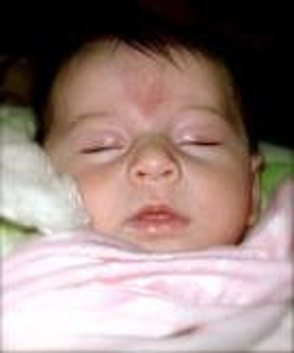 <p>groupings of capillaries near the hairline and eyes, present at birth but do fade</p>