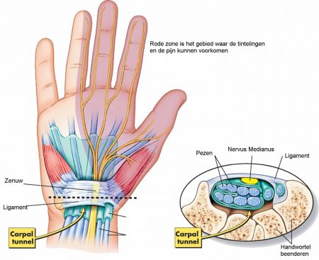 <p><span><span>Hoe wordt de carpale tunnel anatomisch gevormd?</span></span></p>