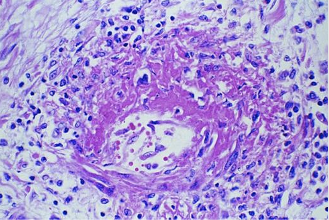 <p>What pathology is shown here?</p>