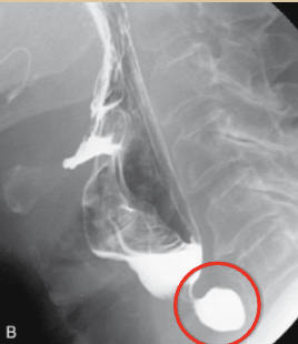 <p>What esophageal disorder is this?</p>