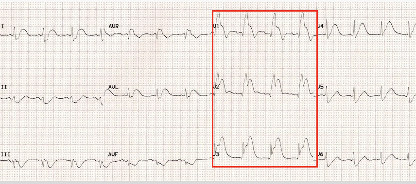 <p>ST elevation in leads V1-4</p>