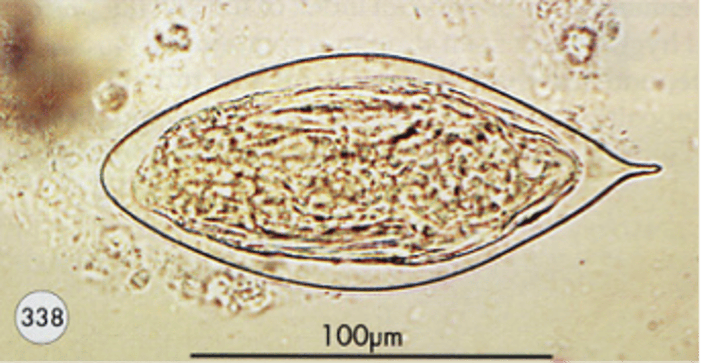 <p>Bladder cancer (squamous cell)</p>