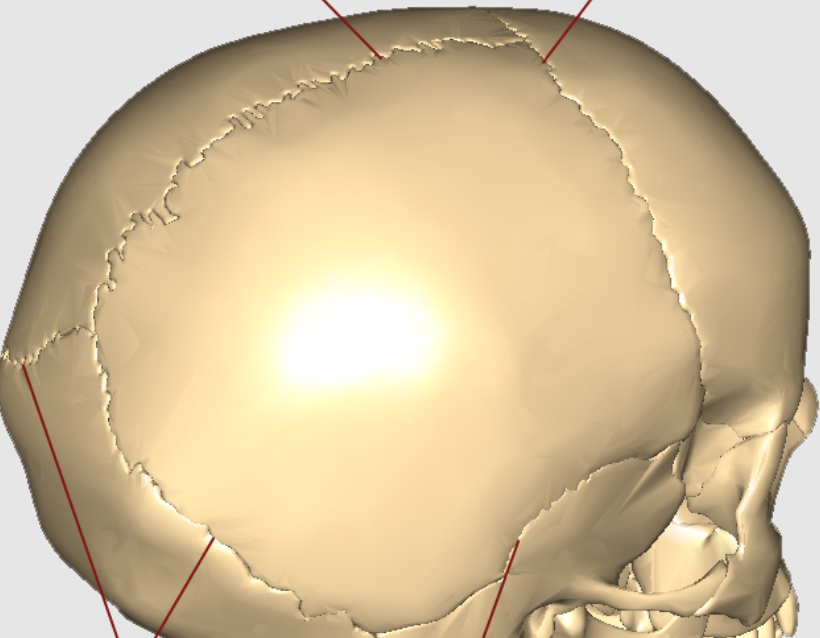 <p>tough, inflexible fibrous joints between the bones of the skull that allow the brain and skull to expand during growth.</p>