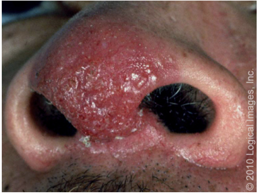 <p>A 35 y/o African American male presents to the clinic for a dry cough and dyspnea. He also reports pleuritic chest pain, fever, night sweats, and that he has loss 20 pounds without trying. On a physical exam you note bluish-red papules/nodules/plaques on the nose and ears and crackles/rales on auscultation of the lungs. CBC shows leukopenia and anemia. ESR is elevated. CMP shows an extremely high calcium. What alarm bells are ringing?</p>