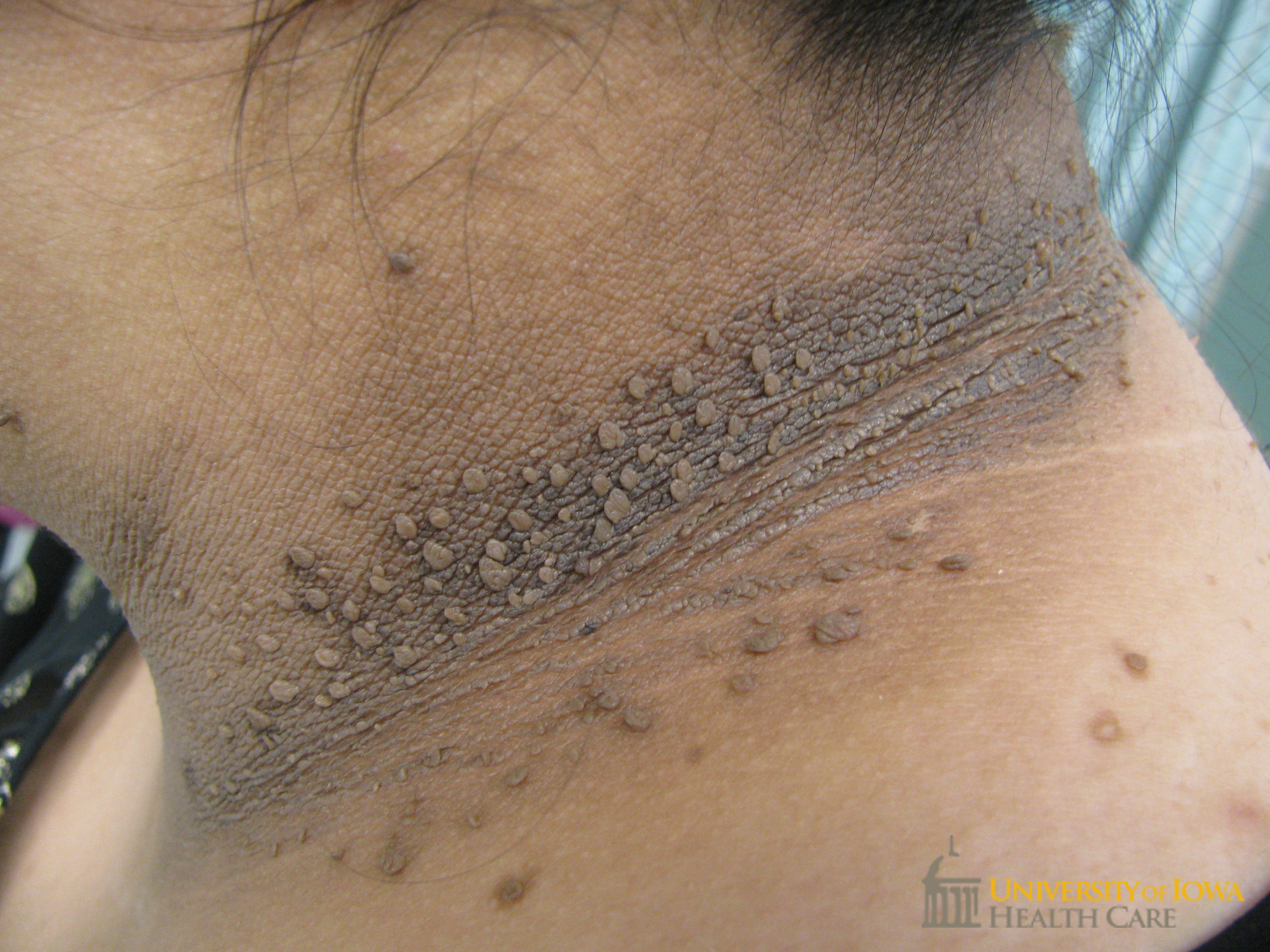 <p>B) Type 2 DM - Acanthosis nigricans is associated with insulin resistance seen in T2DM.</p>