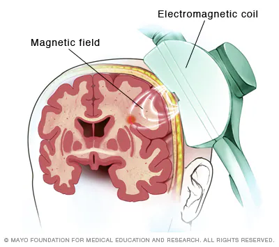 <p><span>is a non-invasive treatment that uses magnetic fields to stimulate nerve cells in specific regions of the brain, typically associated with mood regulation.</span></p>