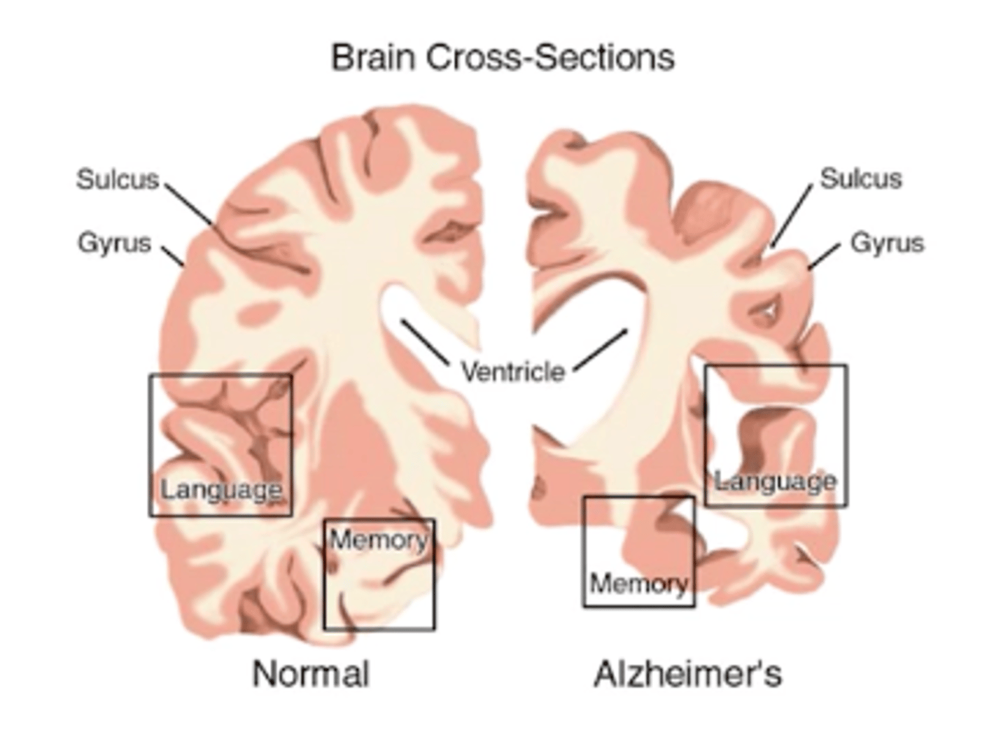<p>cortical atrophy and loss of neurons</p><p>- parietal and temporal lobes</p><p>- ventricular enlargement → hydrocephalus</p>