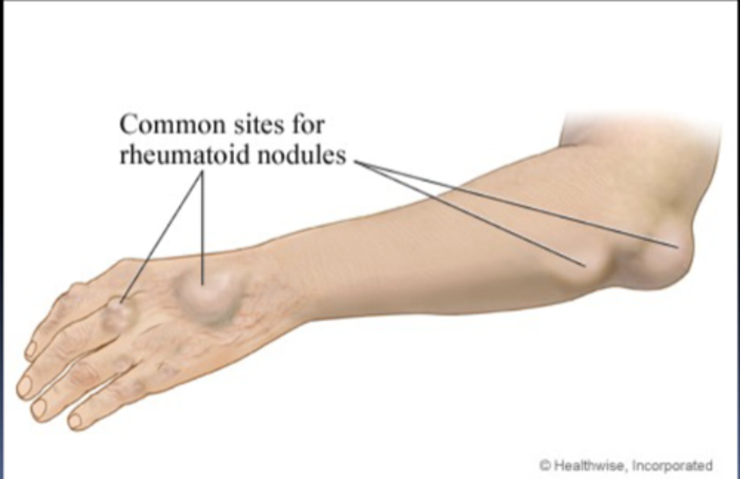 <p>granulomatous and fibrous soft tissue masses found on bony prominences exposed to pressure but can occur in other areas</p><p>be sure to note:</p><p>-location</p><p>-size</p><p>-sensitivity</p><p>-number</p><p>-consistency</p>