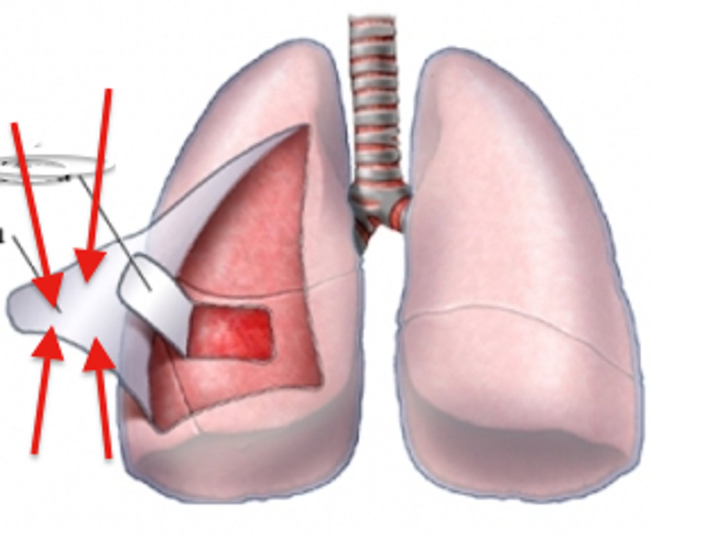 <p>outer layer of pleura lying closer to the ribs and chest wall</p>