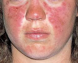 <p>SLE (Systemic Lupus Erythematosus)</p>