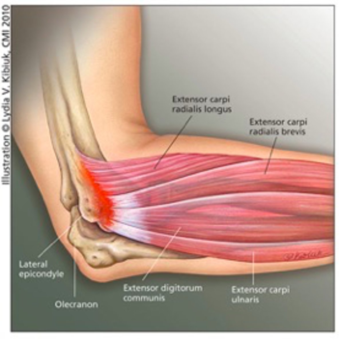 <p>•80-90% resolve with or without tx w/in a year</p><p>•NSAIDS/Activity modifications</p><p>•Bracing: Counterforce brace, wrist brace</p><p>•PT</p><p>•Injection: Corticosteroid, platelet rich plasma (PRP)</p><p>Surgery</p><p>•Release and debridement of ECRB origin</p><p>•Reserved for those with persistent symptoms for over a year</p><p>•70% of patients with good to excellent outcomes</p>