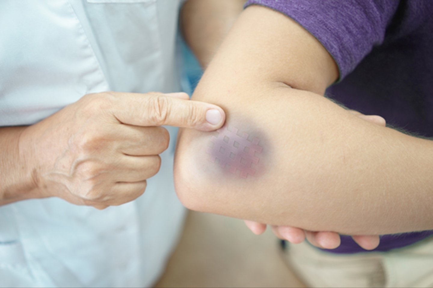 <p>A mechanical injury (e.g., a blow) results in hemorrhage into tissues. Skin is intact. Color in a light-skinned person is usually (1) red-blue or purple immediately after or within 24 hours of trauma and generally progresses to (2) blue to purple, (3) blue-green, (4) yellow, and (5) brown to disappearing.</p><p>-This is due to blood capillaries being damaged. Some causes include injury due to an accident or playing sports. It is usually the result of some type of blunt impact on the body.</p>