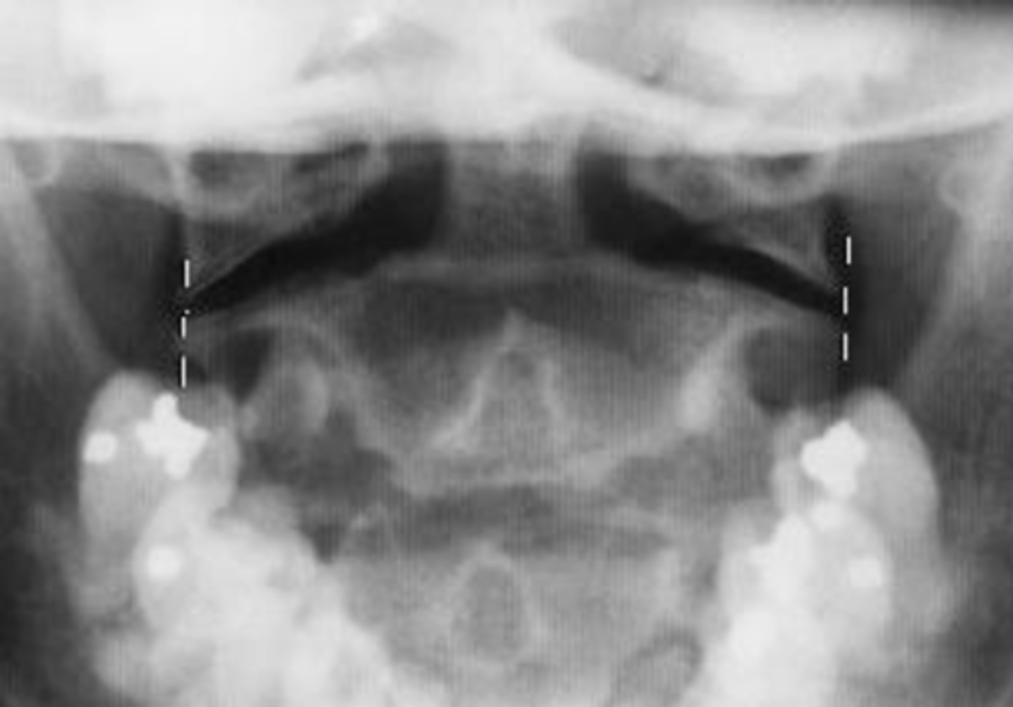 <p>Name the Roentgenometric</p>