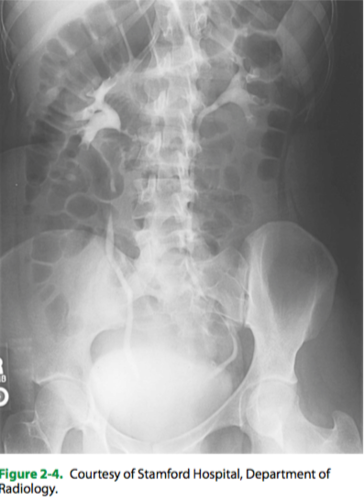 (C) The right ureter is better visualized