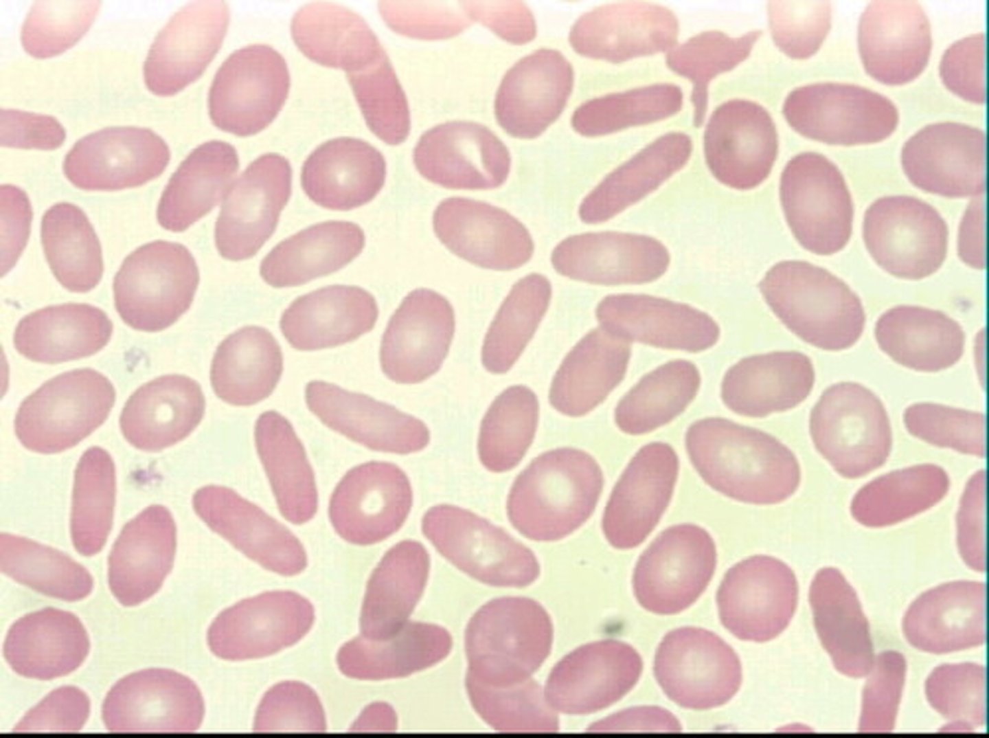 <p>- oval/cigar shaped</p><p>- contains central pallor</p><p>- decrease in membrane cholesterol and/or spectrin</p><p>- cells cannot reform into binconcave erythrocytes</p><p>-Etiology: hereditary ovalocytosiselliptocytosis</p>