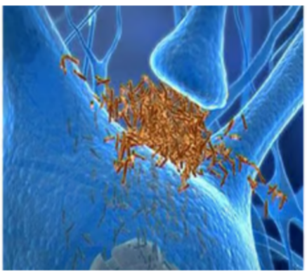 <p><strong>Which neurotransmitter is being interfered with? (use blue synapse photo)</strong></p><p>A- Dopamine </p><p>B- serotonin </p><p>C- glutamate </p><p>D- ach </p><p>E- norepinephrine</p>