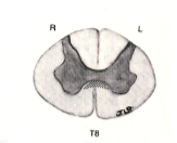 <p>a lesion here would result in what clinical presentation?</p>