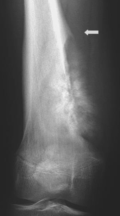 <p>Periosteum lifts away from the bone, seen in osteogenic sarcomas &amp;/or osteomyelitis </p>