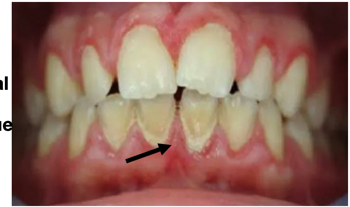 <p>Exfoliated epithelial cells and food debris on the superficial surface of dental plaque.</p>