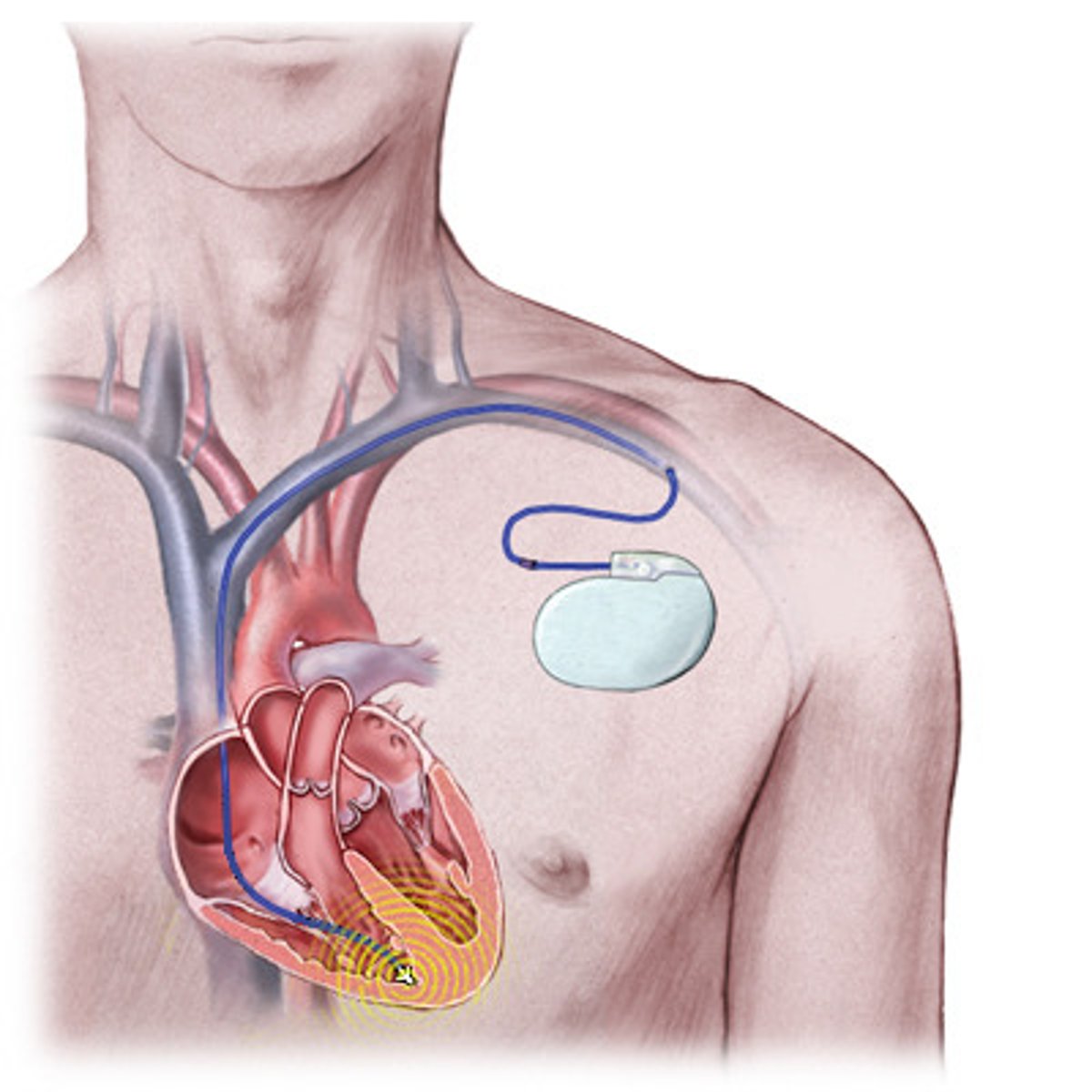 <p>- recognizes ventricular arrythmias</p><p>- cardiovert or defibs (shocks in HIGHER ENERGY LEVEL)</p><p>- ability to pace</p><p>- ability to store retrievable data</p><p>- implanted like a pacer (lasts 3-5 yrs)</p>