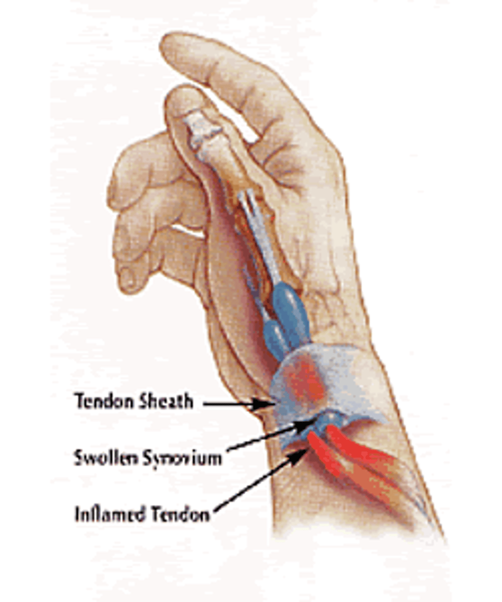 <p>•Swelling and pain over radial styloid</p><p>•Pain with resisted thumb extension or abduction</p><p>•Pain with resisted thumb MCP flexion and adduction</p><p>Pain can radiate down forearm</p><p>ADLs affected: wringing out dishrags, using scissors, typing, closing/opening jars, knitting, racquet sports</p>