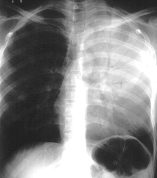 <p>Pattern seen on CXR or CT scans when air-filled bronchi become visible against a background of dense lung tissue. </p>