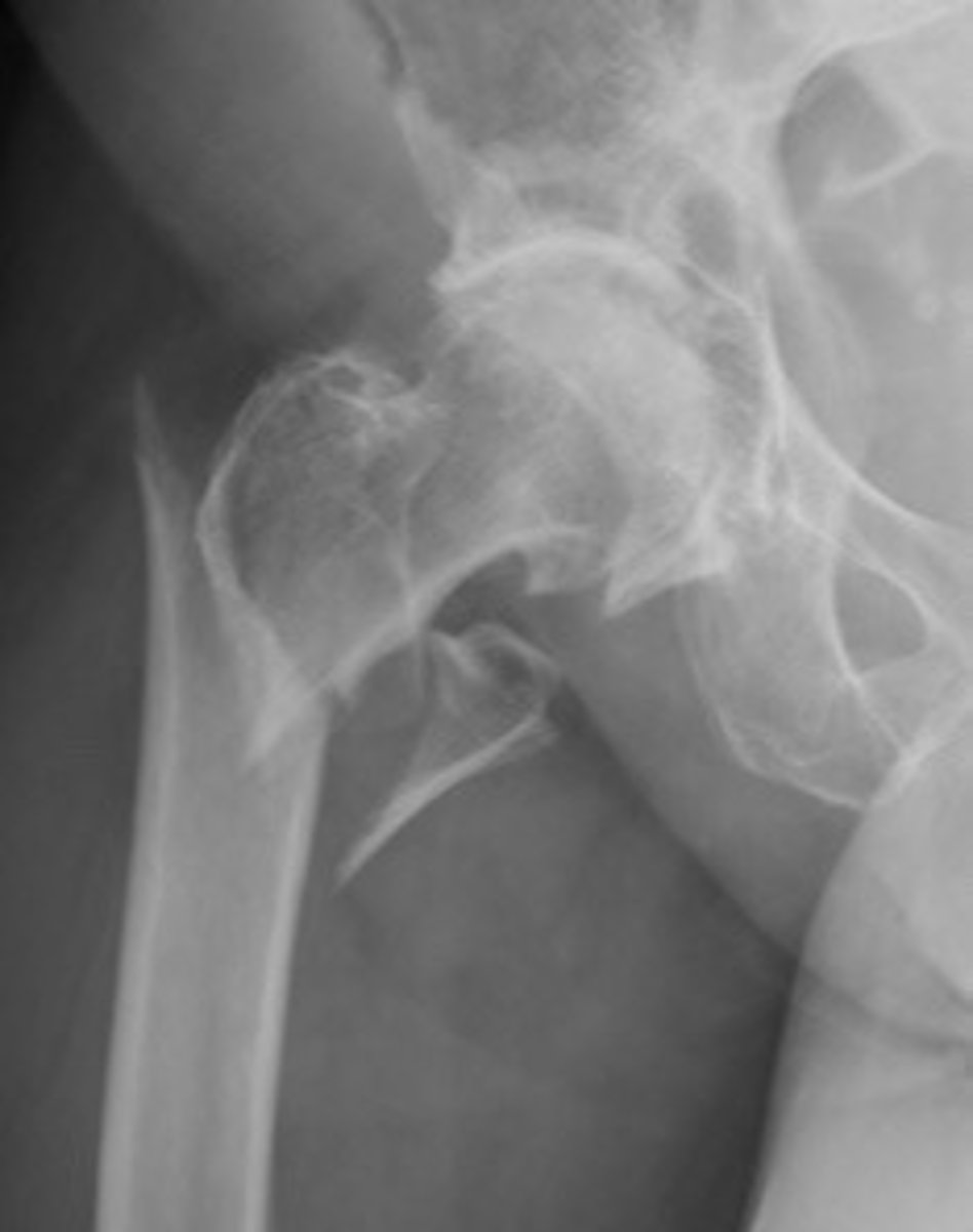 <p>What type of fracture is shown?</p>
