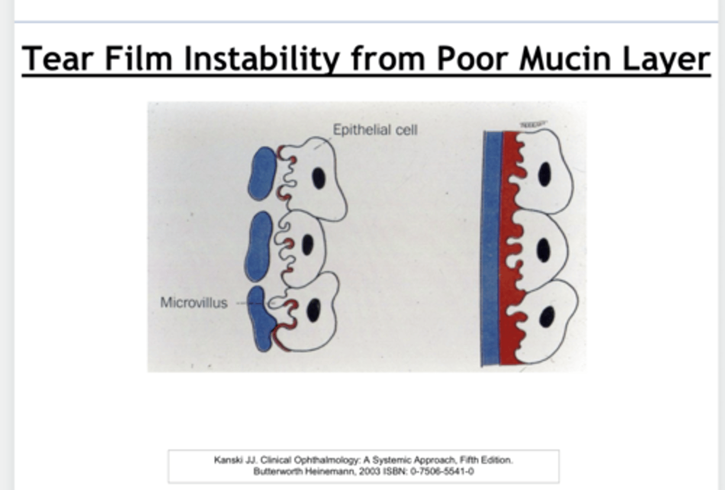 <p>Can tear film instability results from a poor mucin layer on the ocular surface?</p>