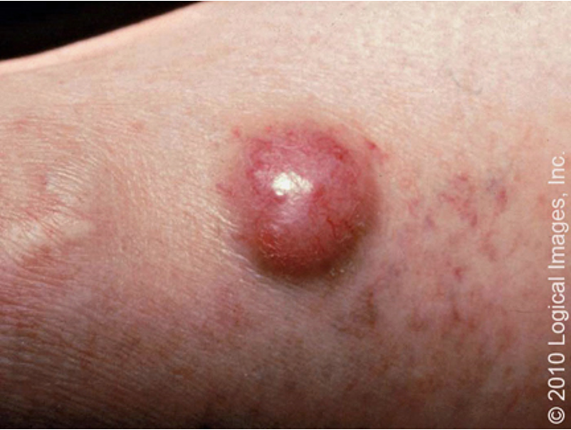<p>rare, aggressive cutaneous malignancy that typically appears in older individuals</p>