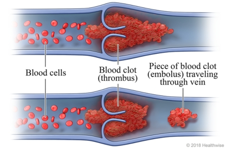 <p>__ is a free floating thrombus in the bloodstream</p>