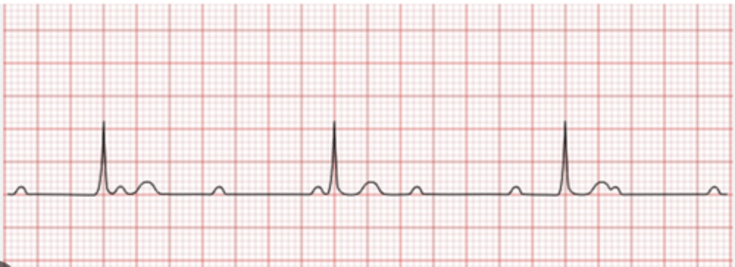 <p>What is this heart block</p>