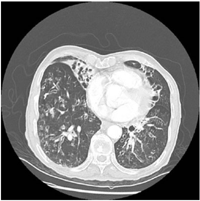 <p>52yo w/ 5-day hx of 100F &amp; productive cough that is difficult to cough up. had similar sx twice yearly over the past 15 years, resolve with abx. no hx. pulse ox 94%. increased expiratory phase, rhonchi, faint wheezes bilaterally</p>